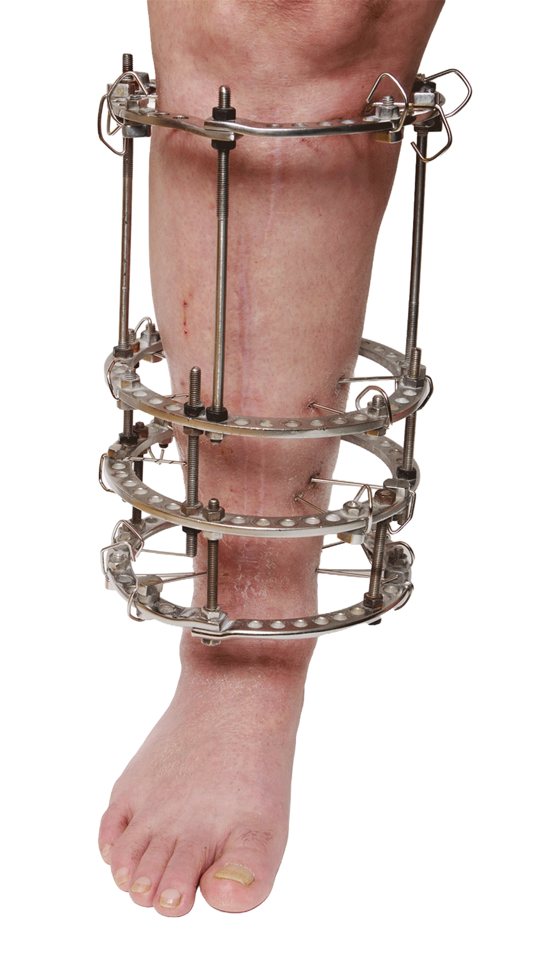 External Fixation